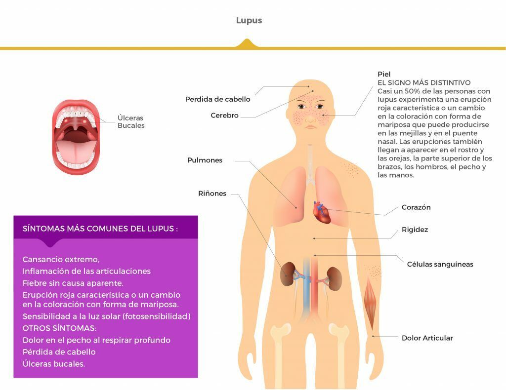 Enfermedades autoinmunes que es el lupus foto 4 nota