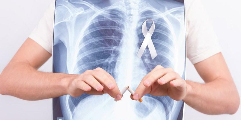 La búsqueda de tratamientos más efectivos y personalizados contra el cáncer de pulmón