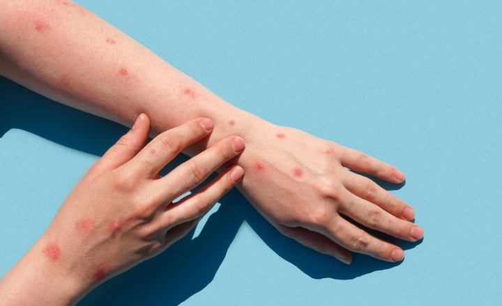  Herpes zóster: todo lo que hay que saber sobre  la infección conocida como “culebrilla”